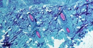 Quattro casi di vaiolo delle scimmie in Italia. Oms: identificazione precoce e isolamento