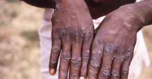 Vaiolo scimmie: segnalato primo caso anche in Lombardia, sono sei in Italia