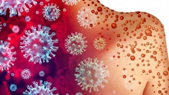 Vaiolo delle scimmie: dal contagio al vaccino, cosa c’è da sapere