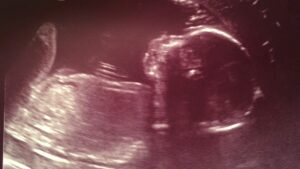I genitori sono “arrabbiati” perché nessuno è stato ritenuto responsabile delle cure del bambino nato morto, tra i timori che lo status di “religione” del Servizio sanitario nazionale sia “pericoloso”