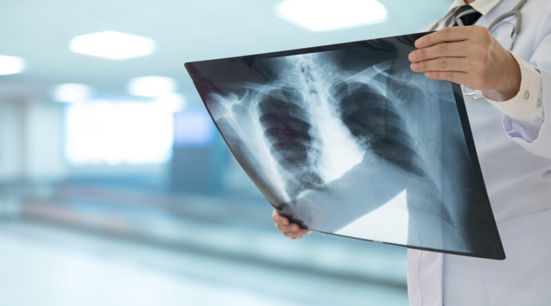 La tubercolosi cresce nei minori e in Italia è boom di casi tra gli under 15