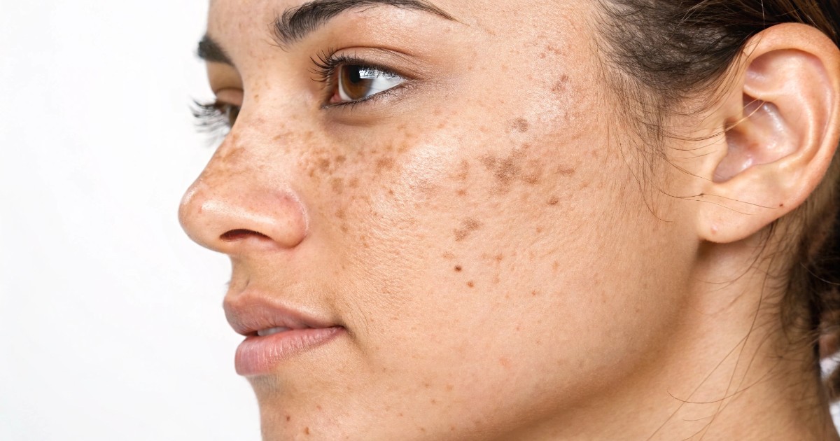 Come prevenire le macchie solari? I consigli della dermatologa: “La pelle ha una memoria, ogni macchia lascia un’impronta”